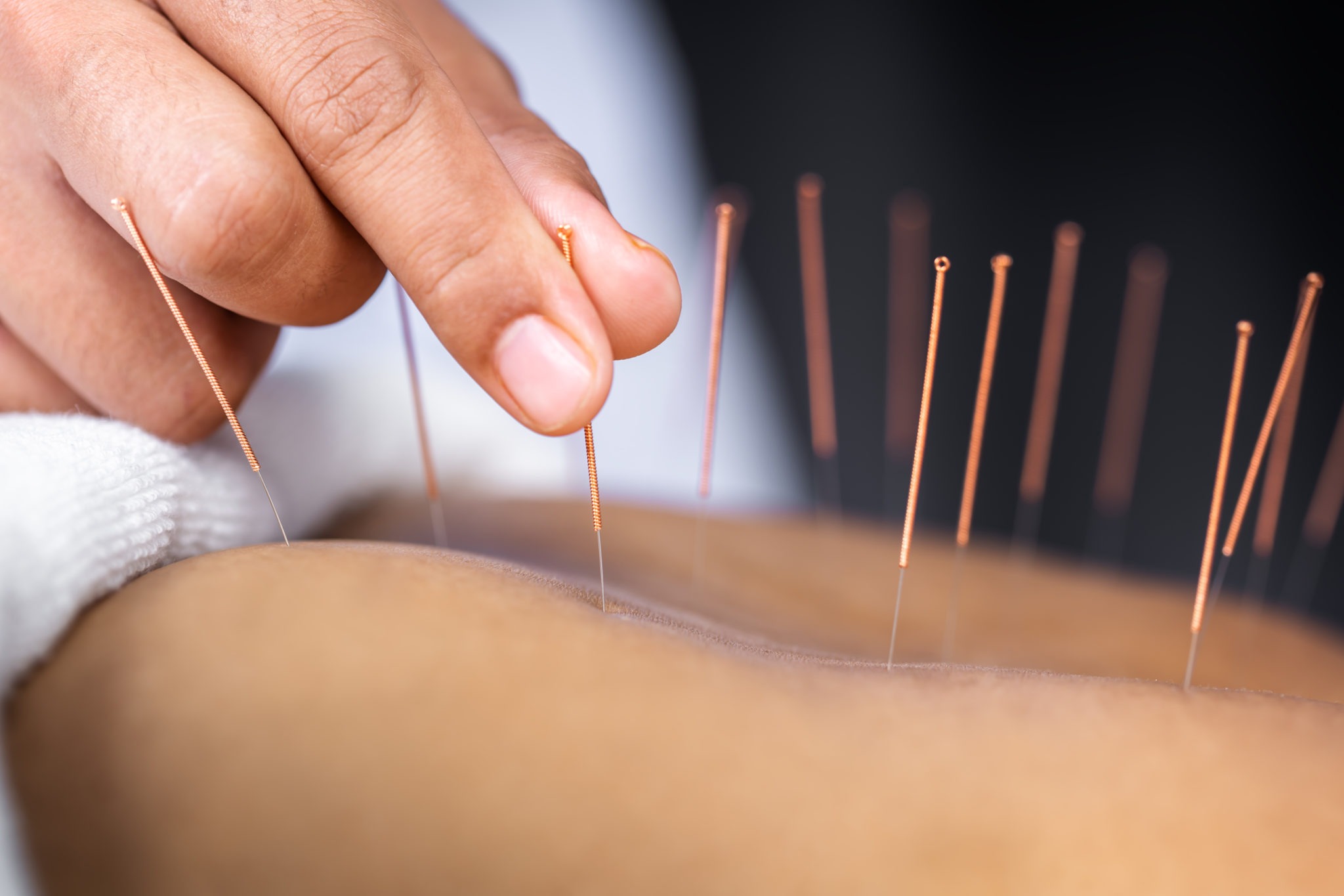 acupuncture needles and fire cupping tools